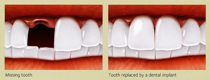 Dental implants replace missing teeth