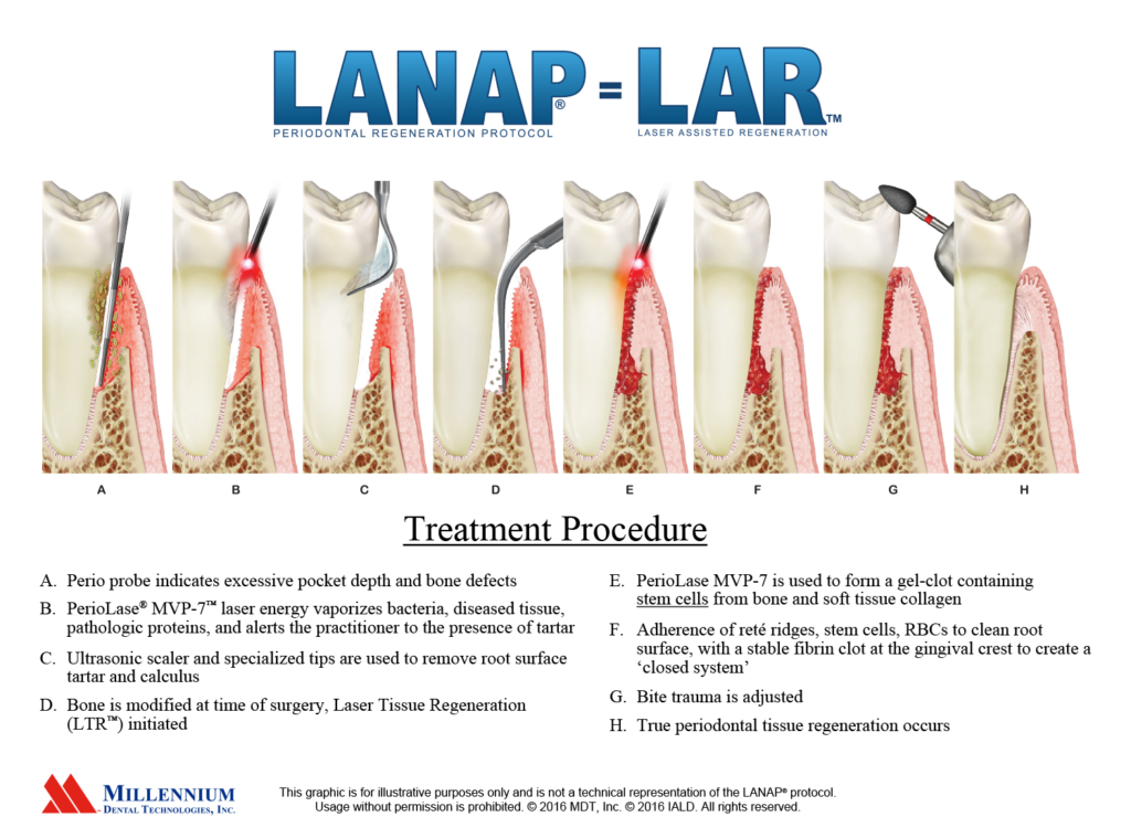 LANAP treatment available in Montrose at the offices of Dr. Werts